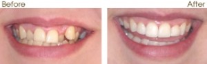 six month smiles adult braces