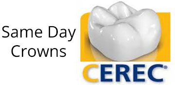 Cerec Same Day Crowns